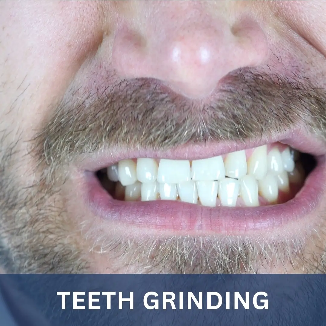 Teeth Grinding - Breaking Habits Burlington Hypnosis
